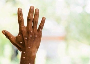 Ikambi y’impunzi z’Abanye-kongo mu Burundi yabonetsemo abarwaye ubushita bw’inkende