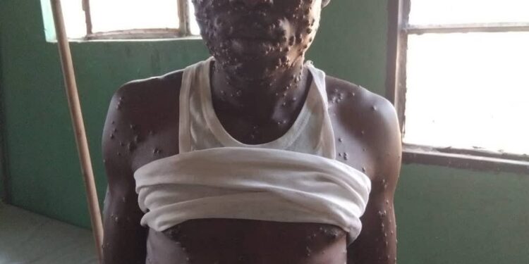 Burundi: Indwara Idasanzwe Yagaragaye kwa perezida Evariste Ndayishimiye